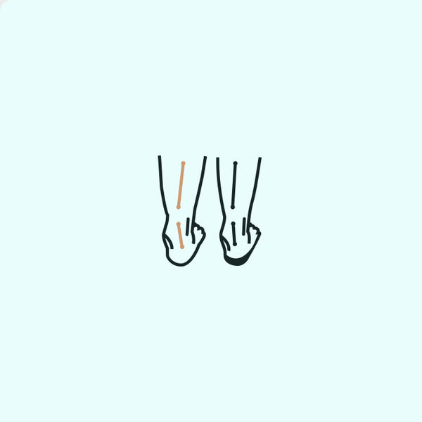 Overpronation